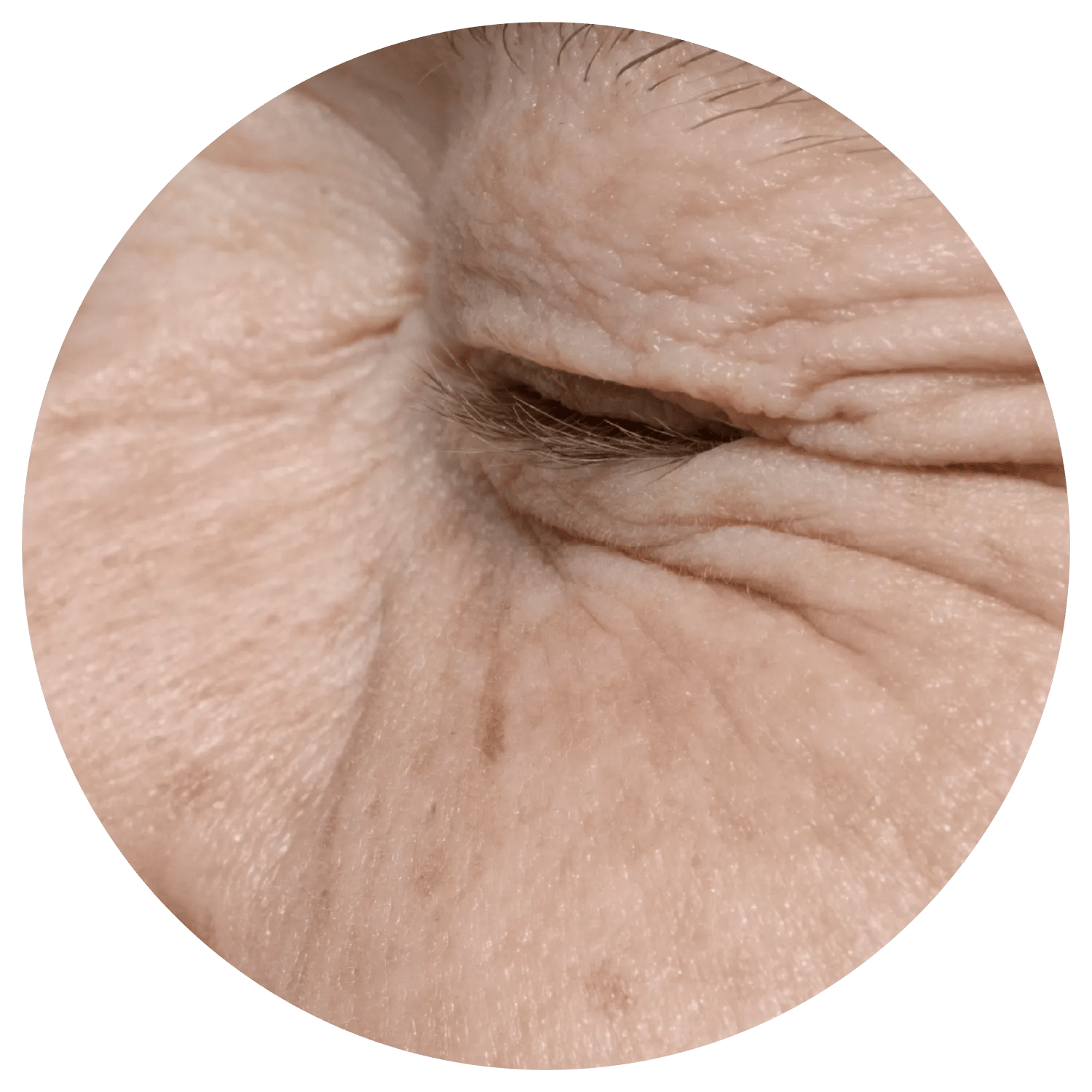 Periorbital Wrinkles treatment process at Toronto medical spa - Understand the root of the lines—beyond the surface.